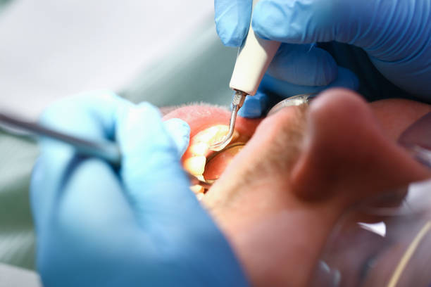 Best Emergency Root Canal Treatment in Sonoma, CA